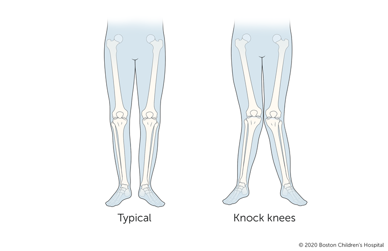 Knock Knees